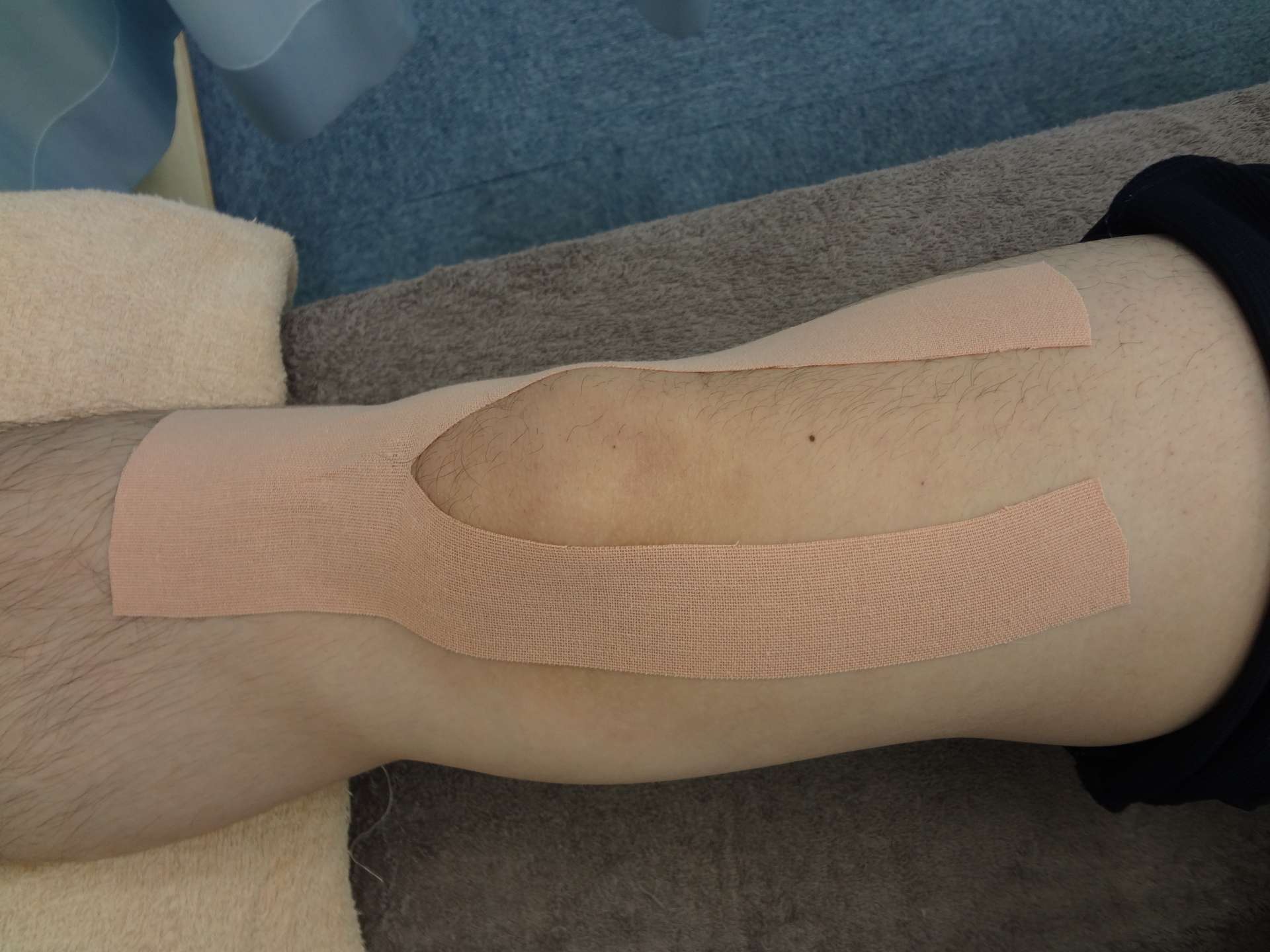 ジャンパー膝を改善する方法